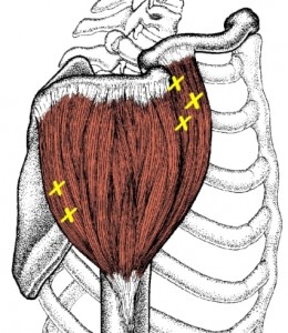 deltoid-side-trigger-points